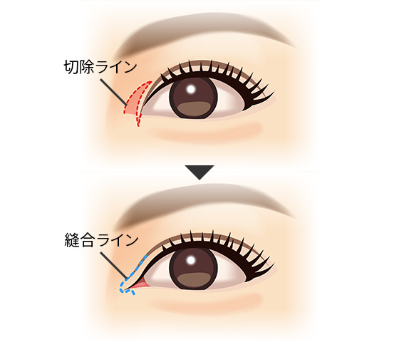 目頭切開による二重まぶた整形 美容整形は東京美容外科
