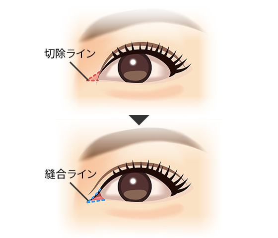 目頭切開による二重まぶた整形 美容整形は東京美容外科 目頭切開による二重まぶた整形 美容整形は東京美容外科
