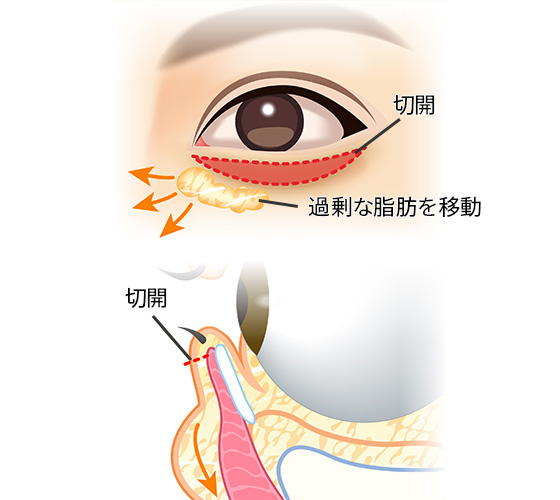 ハムラ法による目の下のたるみ治療 美容整形は東京美容外科 ハムラ法による目の下のたるみ治療 美容整形は東京美容外科