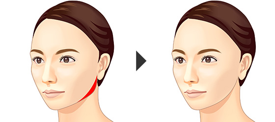 エラ 頬 顎の骨切りによる小顔 輪郭整形 美容整形は東京美容外科