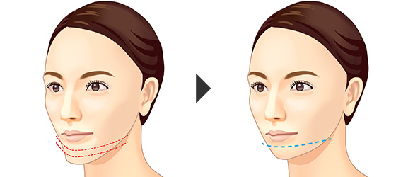 エラ 頬 顎の骨切りによる小顔 輪郭整形 美容整形は東京美容外科