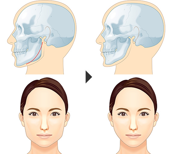 エラ削り 頬 顎の骨削りによる小顔 輪郭整形 美容整形は東京美容外科