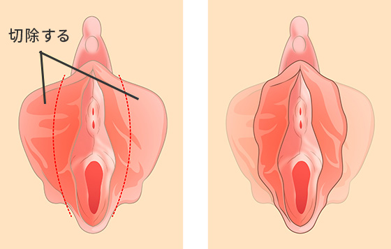 保険適用 しょういんしん縮小手術 自然な小陰唇縮小手術｜吉祥寺ビューティークリニックで