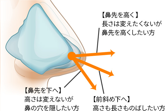 軟骨を挿入説明画像