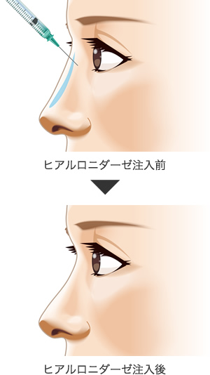 鼻ヒアルロン酸注入 鼻筋を高くする 美容整形は東京美容外科