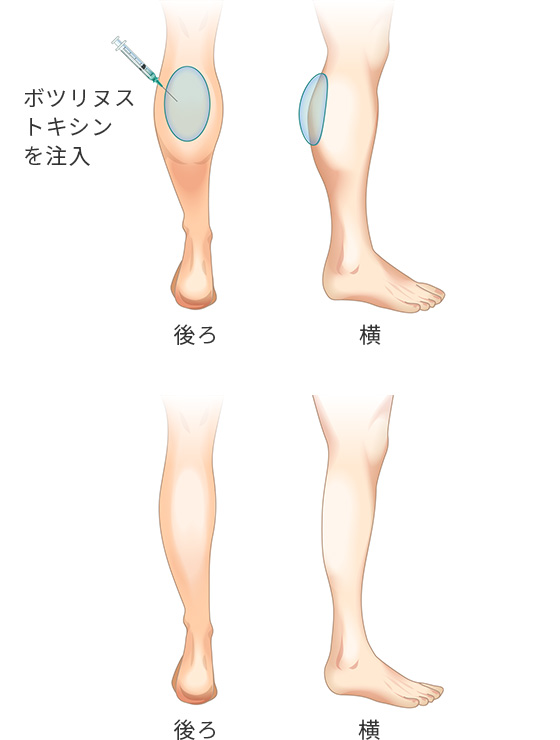 両下腿ボツリヌストキシン 脚痩せ 美容整形は東京美容外科